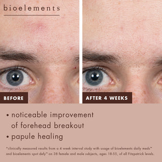 Before: Visible forehead breakouts. After four weeks: Noticeable improvement of forehead breakout. Papule healing. Clinically measured results from a 4-week interval study of daily meds and spot defy on 38 female and male subjects ages 18=55 of all Fitzpatrick levels.