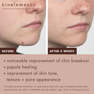 Before: Visible breakouts, papules and pores on chin. After four weeks: Noticeable improvement of chin breakout. Papule healing and improvement of tone, texture and pores. Clinically measured results from a 4-week interval study of daily meds and spot defy on 38 female and male subjects ages 18-55 of all Fitzpatrick levels.