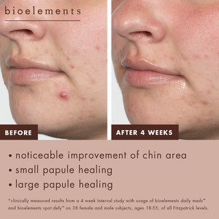 Before: Visible breakouts and papules on chin. After four weeks: Noticeable improvement of chin area, small and large papule healing. Clinically measured results from a 4-week interval study of daily meds and spot defy on 38 female and male subjects ages 18-55 of all Fitzpatrick levels.