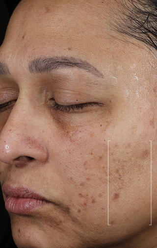 Close-up of a person's face with visible skin texture and pores.