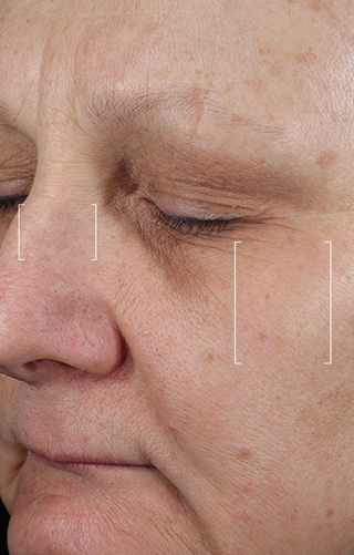 Close-up of a person's face with visible skin texture and pores.