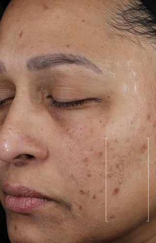 Close-up of a person's face with visible skin imperfections.