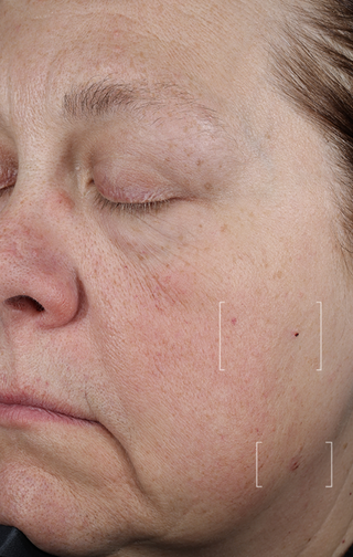 Close-up of a person's face with visible skin texture and pores.