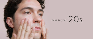 Acne in your 20s: causes + solutions