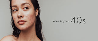 Acne in your 40s: Adult acne causes + solutions