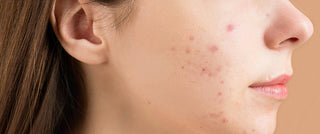 Ask the skin care expert: what's causing my acne?