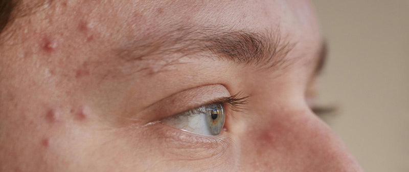 Non Inflamed Inflamed vs non-inflamed acne: what’s the difference + how to treat bo ...
