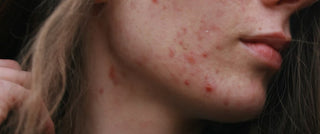 Skin purging vs. breakouts after a facial: how to tell the difference