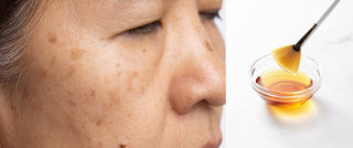 The best facials for hyperpigmentation: what really helps fade dark spots fast