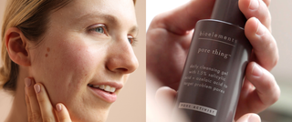 10 acne myths estheticians wish people would stop believing