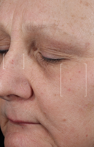 Close-up of a person's face with visible skin texture and lines.